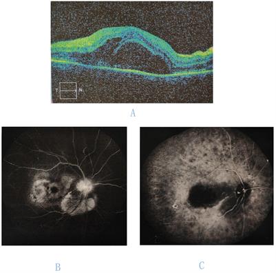 Atypical presentation of acute retinal necrosis mimicking Vogt-Koyanagi-Harada disease leading to misdiagnosis: a case report